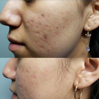 Microneedling for acne scars after 2 treatments