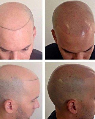 Scalp Micropigmentation for thinning balding hair,  recreate hair lines or add density for men and women.