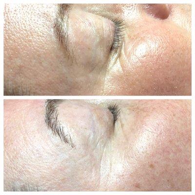 Microcurrent with focus on under eye. Nice lift and contour , and a happy client!