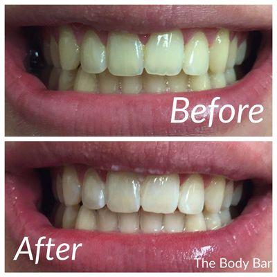 Before and after teeth whitening. Instant results after only 45 minutes!