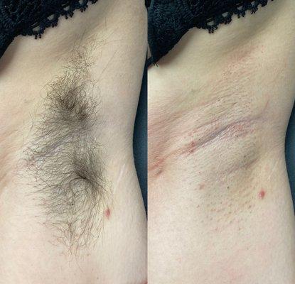 Underarm Wax