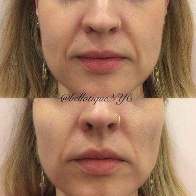 Cheek Augmentation