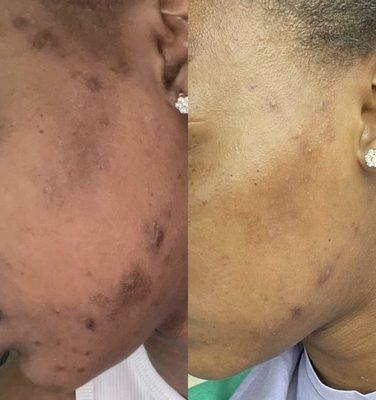 Chemical Peel Transformation 
(Left Photo- before, Right Photo- after)