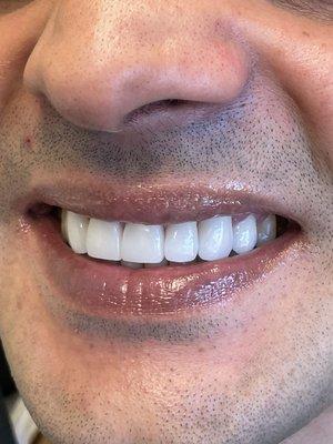 Porcelain veneers