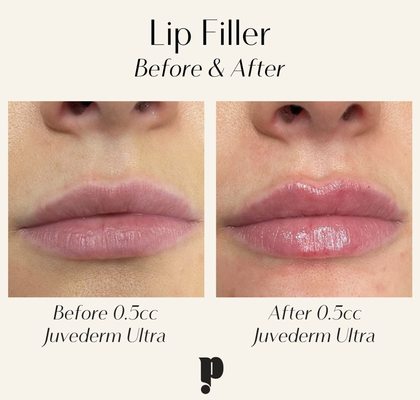 0.5cc of Lip Filler by Alyssa