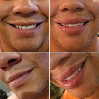 Men get lip filler too! Results after 1cc of Juvederm Ultra for a fuller lip that doesn't disappear when smiling.