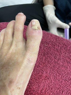 My infected toe