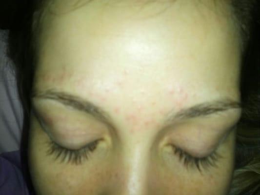 Full of pimples and irradiation after threading. Her forehead was clear prior to threading.