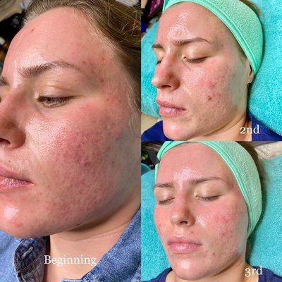 Helping to clear acne and reduce scarring with a series of Microcurrent treatments