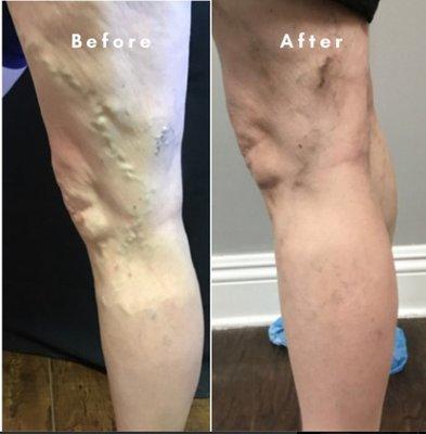 The customized treatment for the visible veins