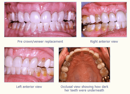 Patient presented w/ veneer crowns which were no longer esthetic. She had previous dark staining on her teeth which required ...