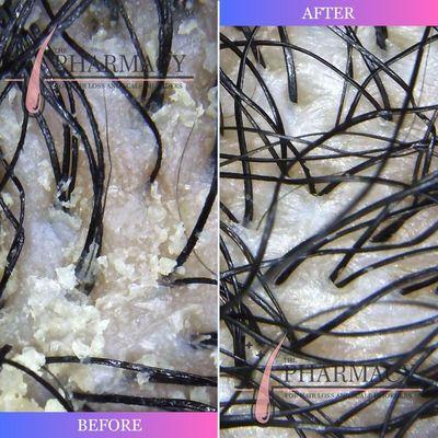 Scalp Dermatitis Treatment - Before & After