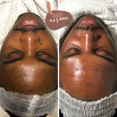 Before and After Classic Facial