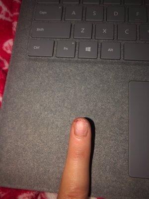 technician ruined my nail