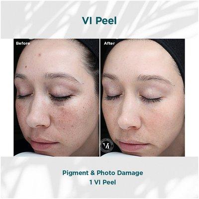 Vi Peel. hyperpigmentation treatment. Works with all skin types