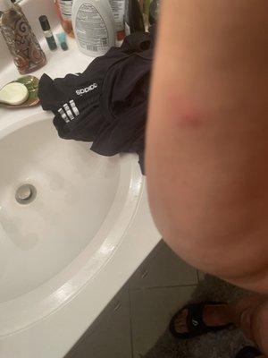 Elbow suffered bite from Bed Bugs in hotel mattress