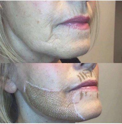 Jowls lift and upper/lower lips wrinkles removed