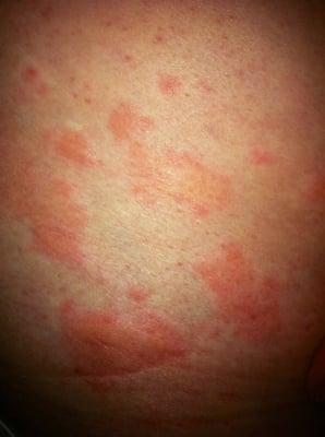 Urticaria (hives) May be a result of allergy or another health abnormality