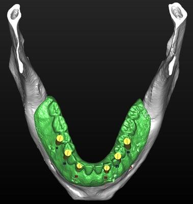 Implants by Paresh uses the latest in technology for your comfort and esthetic implant crowns