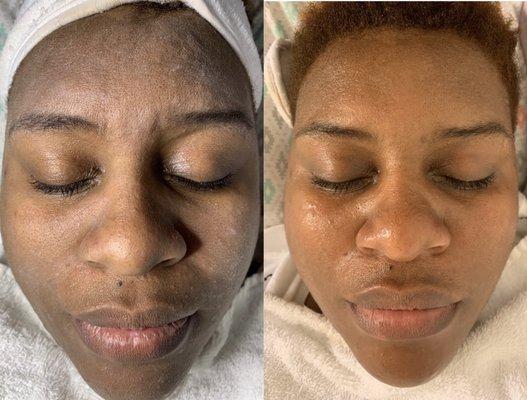 Microdermabrasion