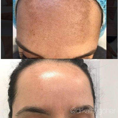 Fraxel laser before and after