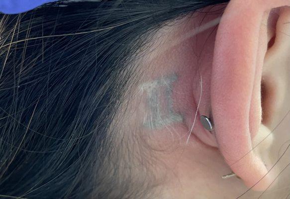 Getting started on removing this behind the ear tattoo.  Treatment 1 complete!