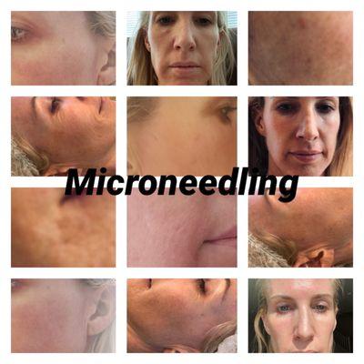 Microneedling First session before and after.