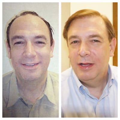 Lance Wegner 3 years after having hair transplant at Renew Hair & Cosmetic Center. He looks great!!