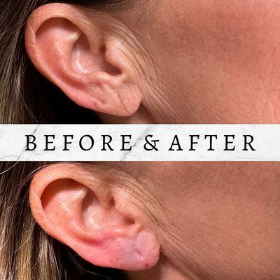 Earlobe Rejuvenation