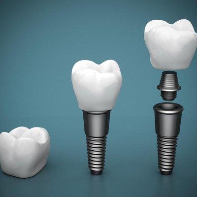 Kiwan Dental  Care & Dental Implants  Center