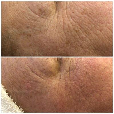 Two sessions of Microneedling 6 weeks apart. Top photo before, bottom photo 6 weeks after second session.  @ CPMedSpa Laser & Skin