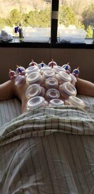 Silicone Cup Therapy and Hard Cup Therapy to release cranky muscles.  Book an appointment today! www.nmtsports.com