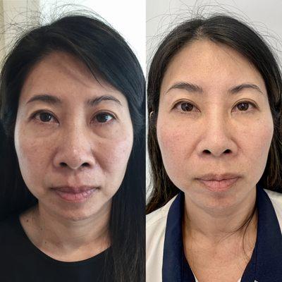 Our combination therapy of synergistic lasers and microneedling can produce dramatic results.