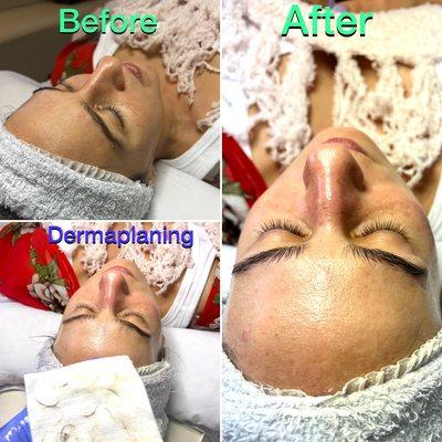 Dermaplaning