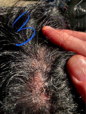 BURNED SCALP (PUSS SPOTS)