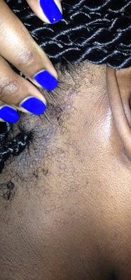 I developed a rash from the Shampoo or dirty tools Flokay Hair Braiding used