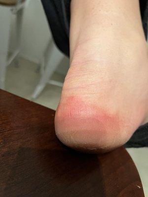 An abused foot