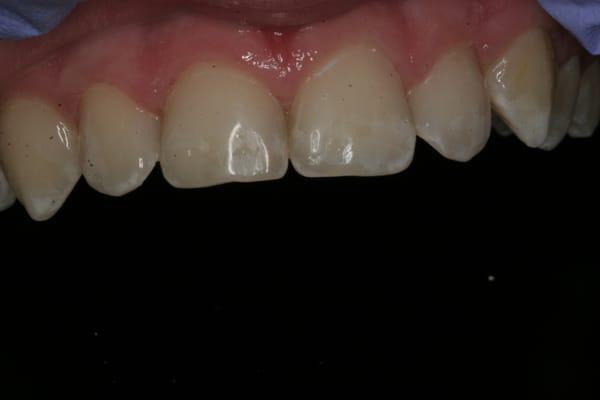 The same patient after Dr. Mike repaired his teeth using chair side composite.