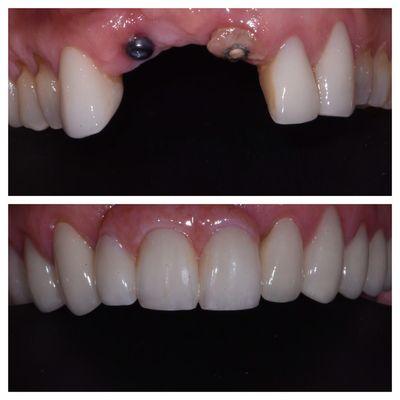 Anterior Implants