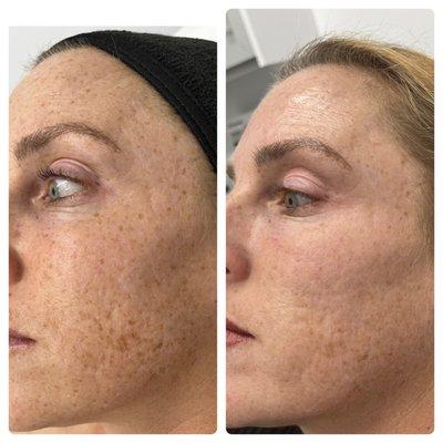 Post one session of The Perfect Derma Peel