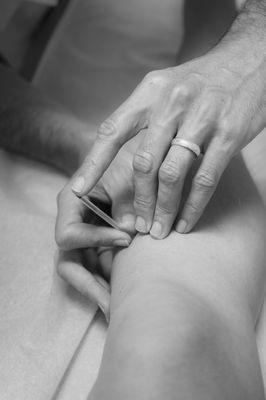 Acupuncture treatment for pain relief