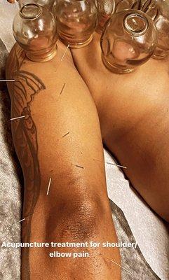 Acupuncture in conjunction with fire cupping treatment for shoulder/elbow pain