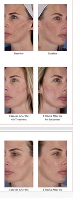 Melasma laser treatments