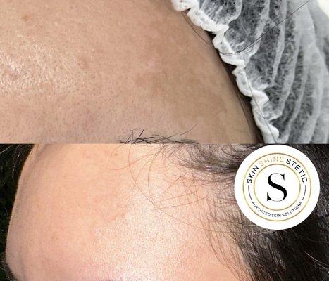 Before & After hyperpigmentation treatment.
The 20/80 system: 20% in clinic, 80% at home.