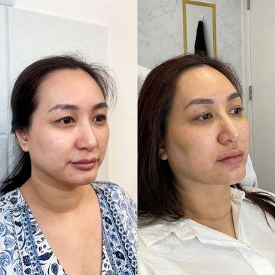 Facial rejuvenation before and after, 1 week apart