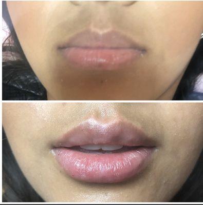 Hyaluronic Acid Lip Filler ( Needle less) 200$ Last up to 3-6 Months