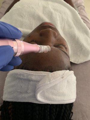 Microneedling