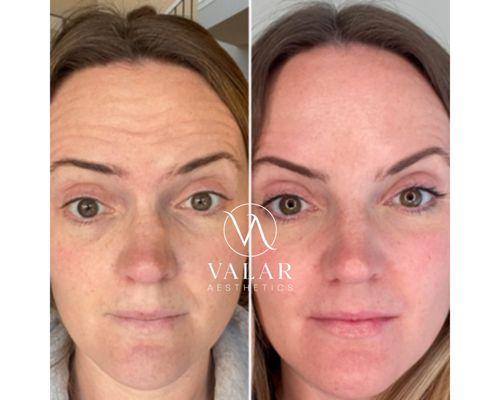 Before and afters of forehead Xeomin injections - our preservative-free botox-equivalent