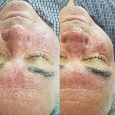 Rosacea Treatment