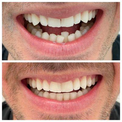 Invisalign before and after